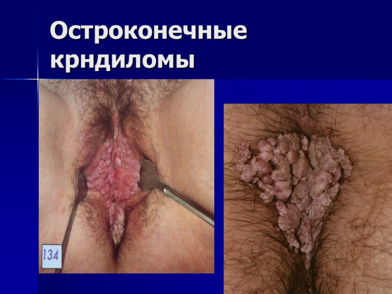 Остроконечные крндиломы